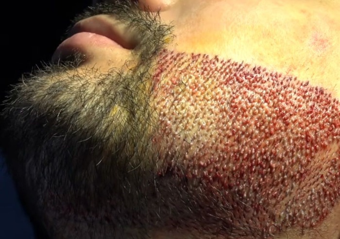 Patient immediately after his beard transplant