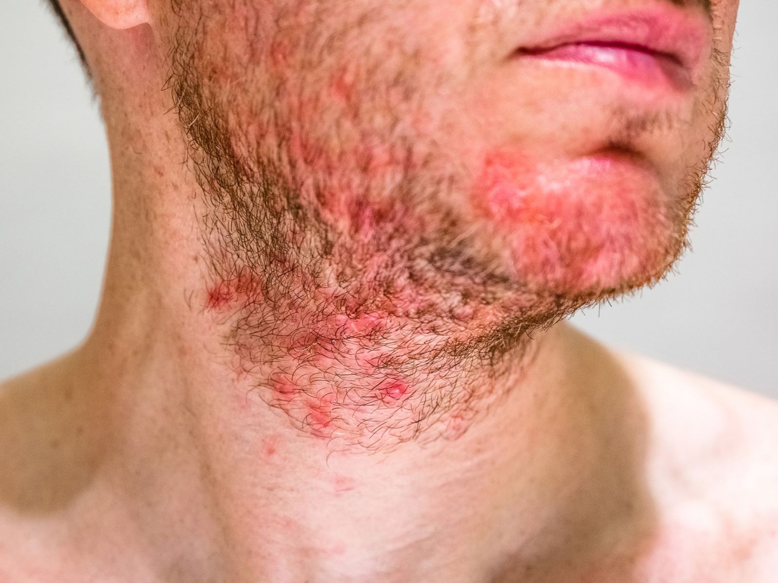 Patient with a beard transplant complication