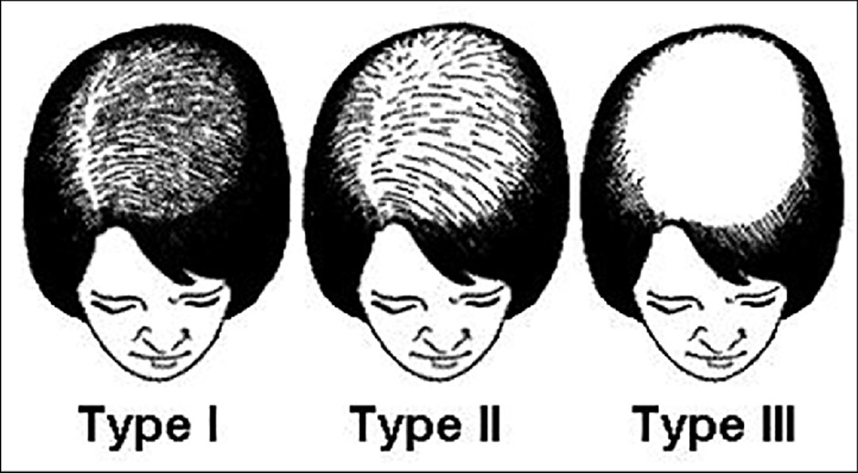 Ludwig Scale showing development of female pattern hair loss.