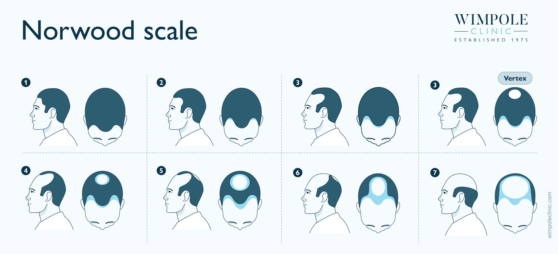 Norwood Scale showing development of male pattern baldness.