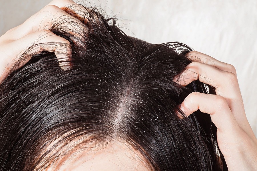 10 Science-Proven Ways To Get Dry Scalp Treatment At Home