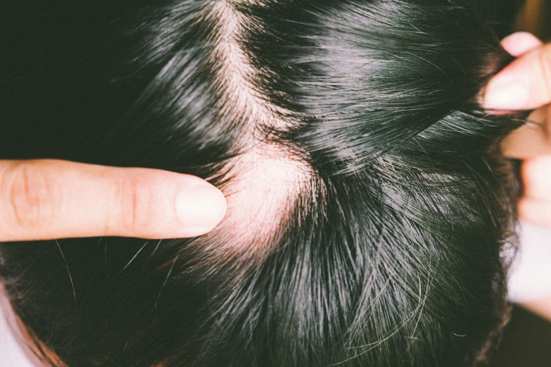 Alopecia areata bald spot