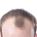 10 Ways To Deal With A Bad Receding Hairline