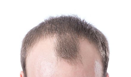 Bad Receding Hairline