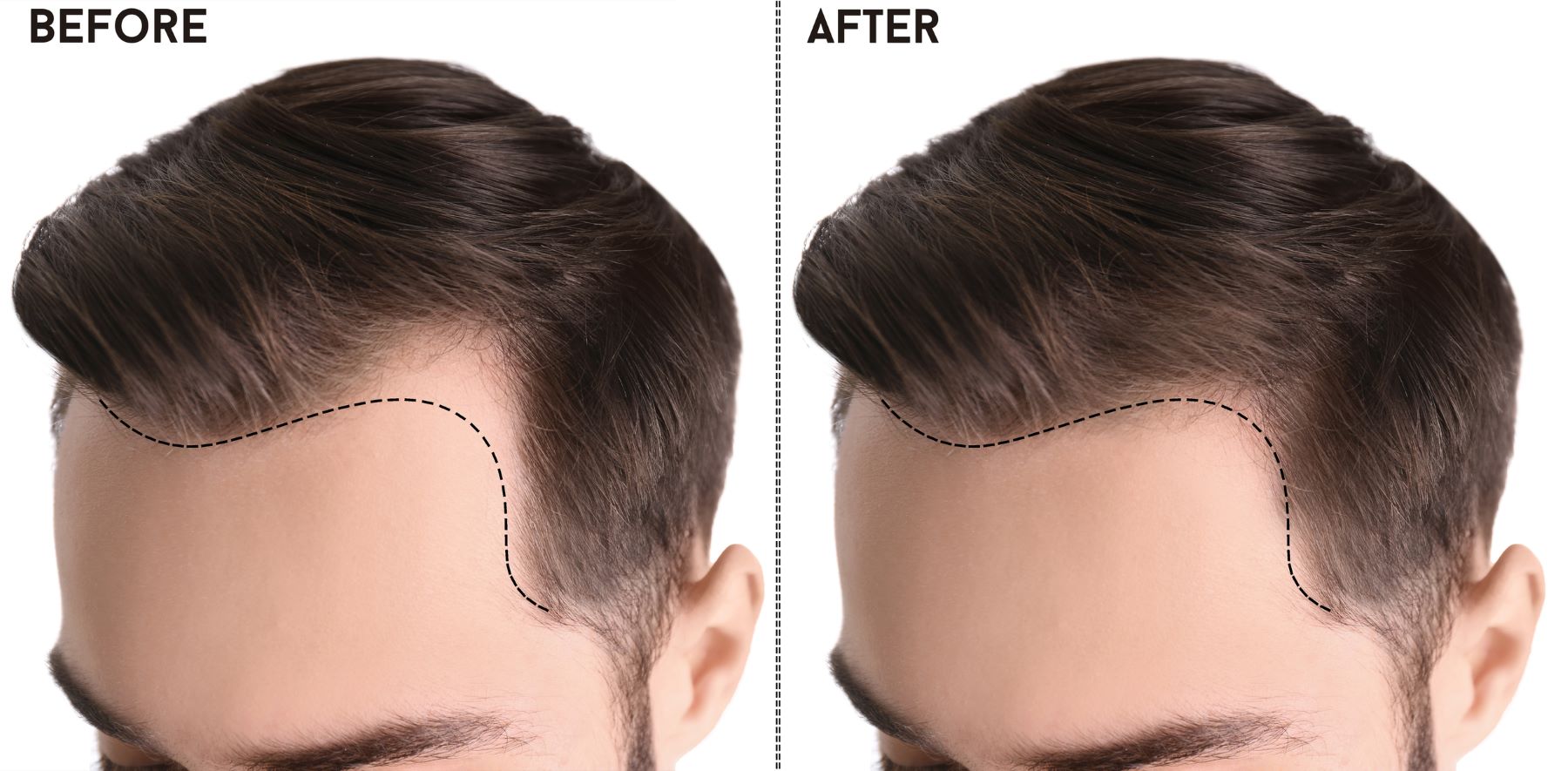 Before and after a hairline transplant