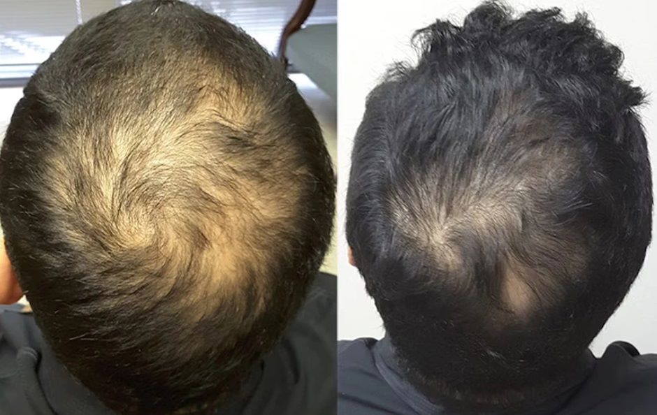 Before and after a year of Minoxidil use for male pattern baldness.