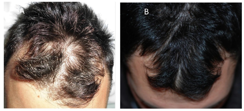 Before and after three PRP sessions for male pattern baldness