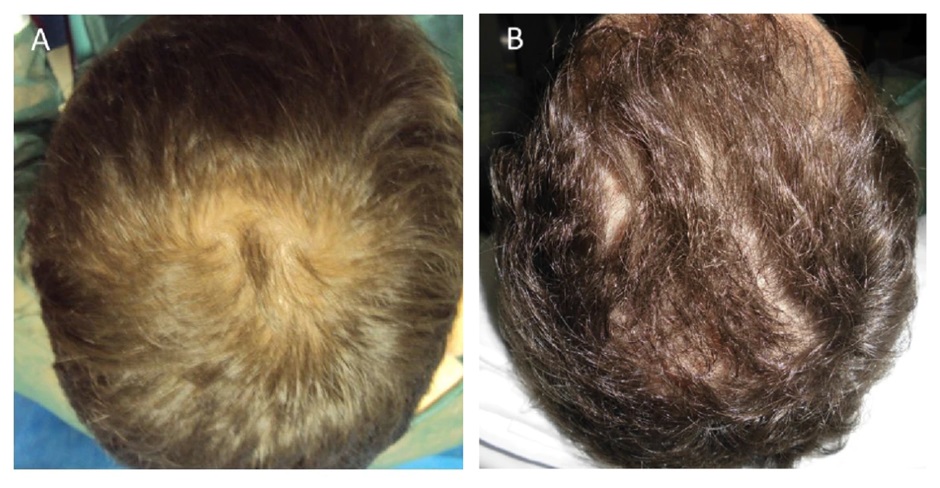 Before and after three months of PRP therapy for male pattern baldness