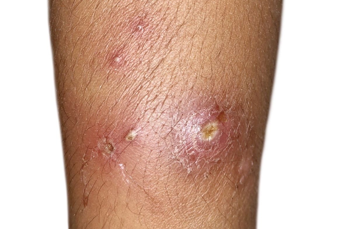 Boils on patient’s leg