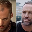 Calum Best’s Hair Transplant: Why Did He Need Six Procedures?