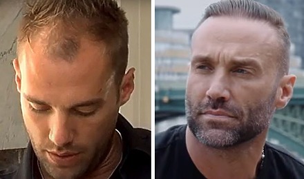 Calum Best Hair Transplant