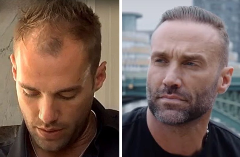 Calum Best hair transplant