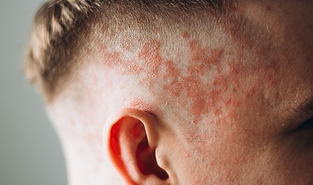 Can Scalp Eczema Cause Hair Loss (and How Do You Treat It)?