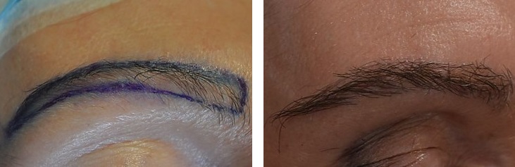 Eyebrow transplant performed at the Wimpole Clinic