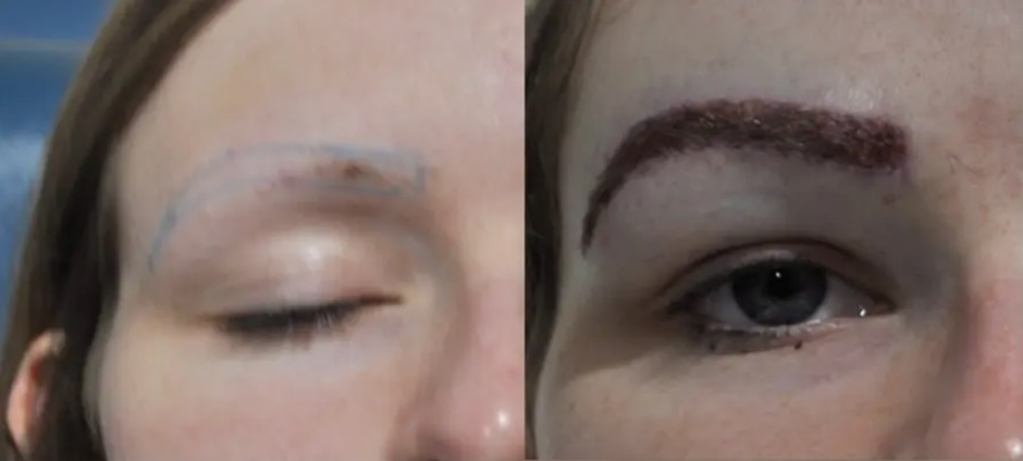 Patient before and after eyebrow transplant