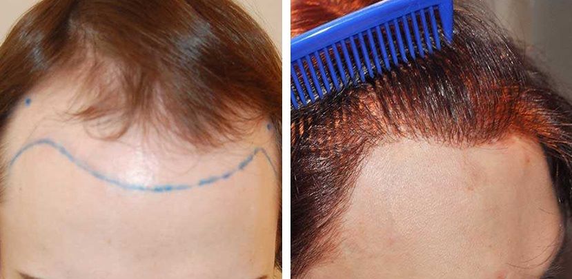 FUT MtF hair transplant before and after