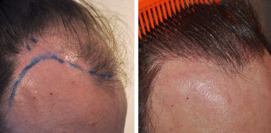 FUT MtF hair transplant before and after