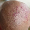 Hair Follicle Infection: Symptoms, Prevention And Treatment