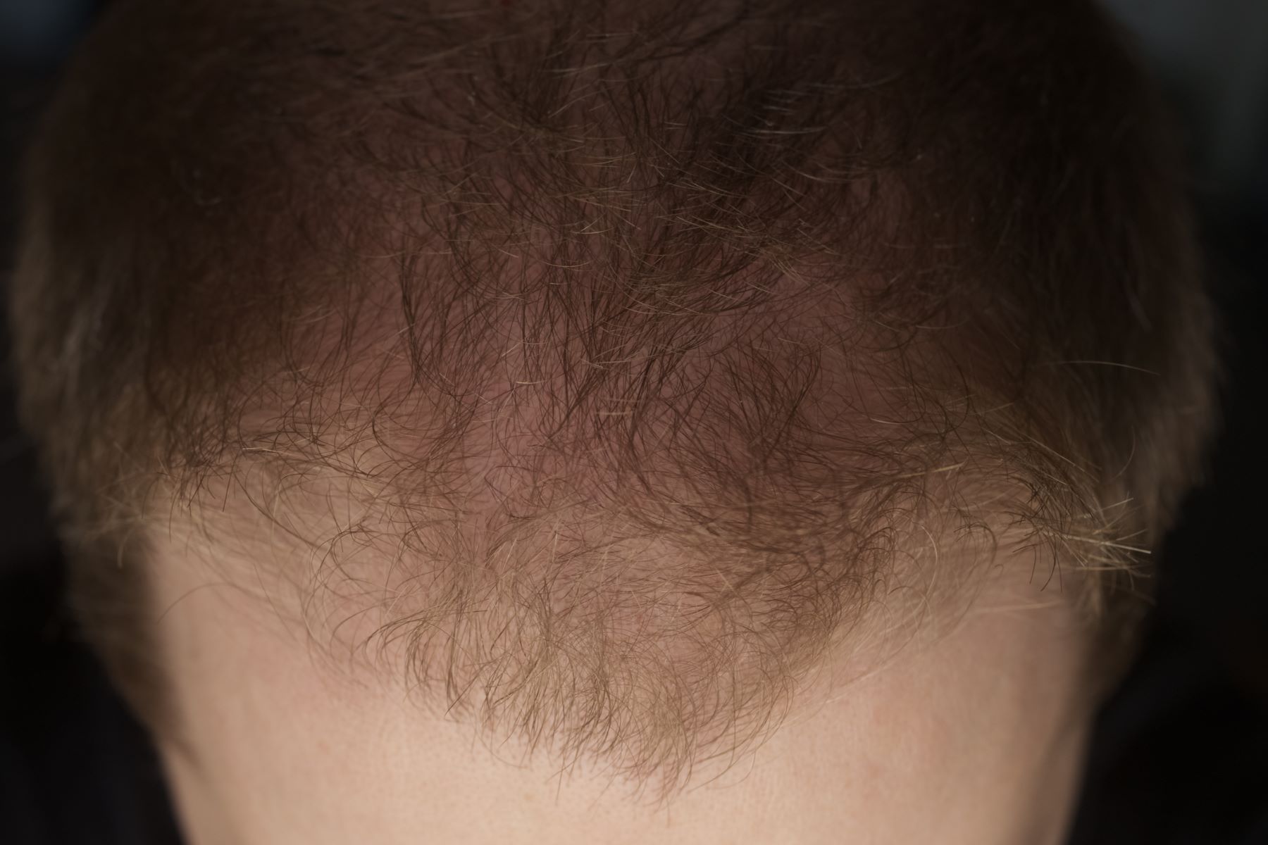 Hair follicle miniaturisation in male pattern baldness