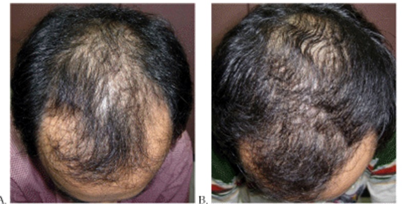 Hair growth before and 1 year after 1mg Finasteride use.