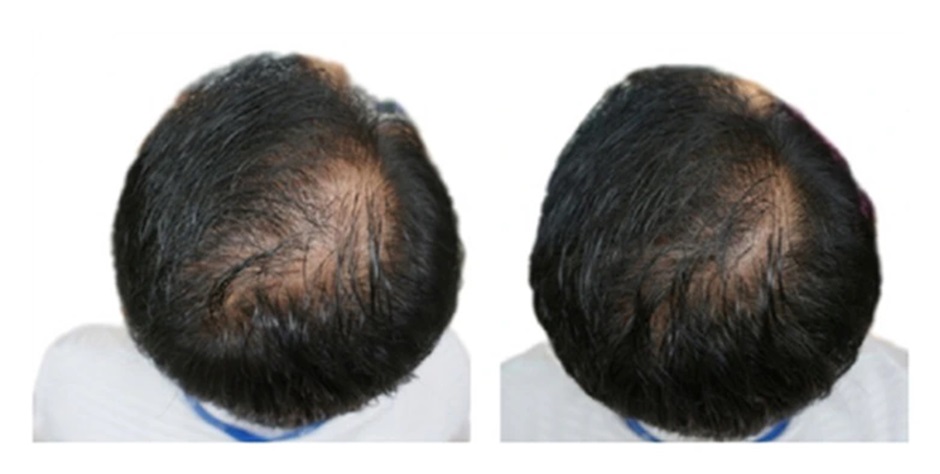 Hair growth before and 24 weeks after daily pumpkin seed oil supplementation.