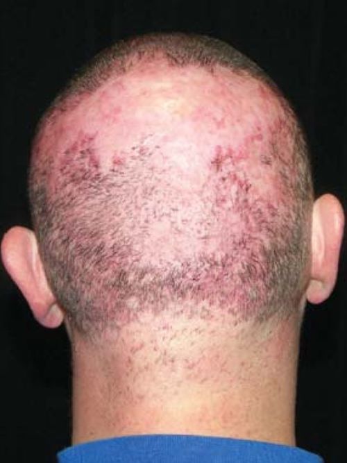 Male patient with hair loss caused by infection