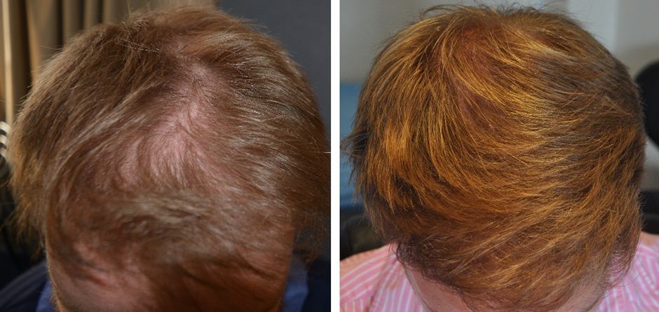 Man before and after a hair transplant