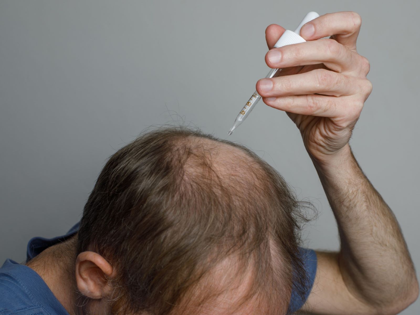 Man using hair loss treatment