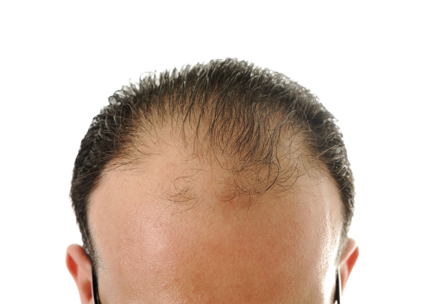 Man with stage 5-6 receding hairline