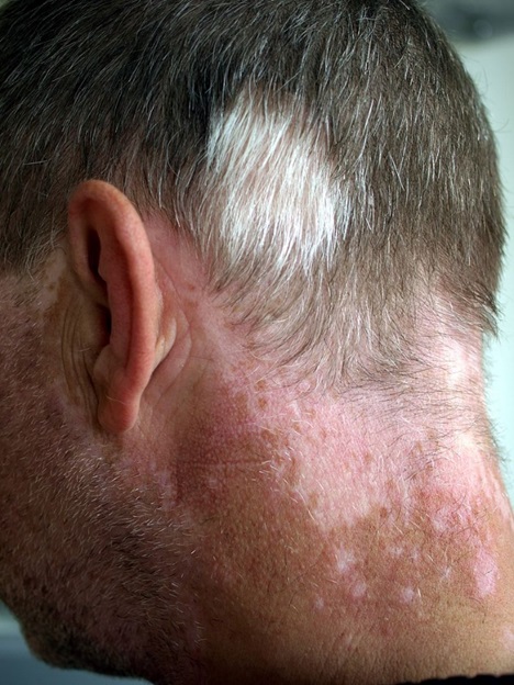 Man with vitiligo-induced poliosis