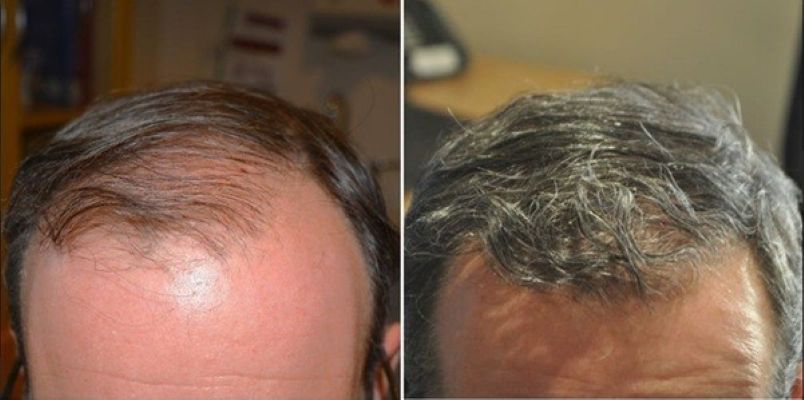 Patient before and after hairline hair transplant