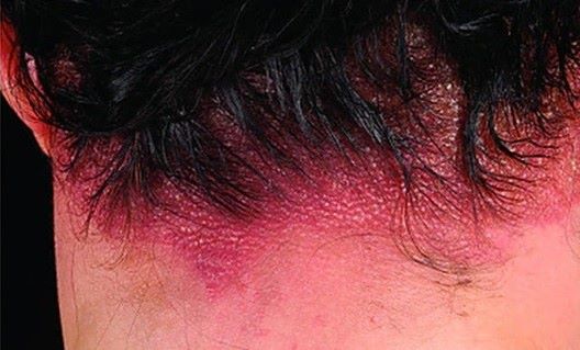 Patient with contact dermatitis