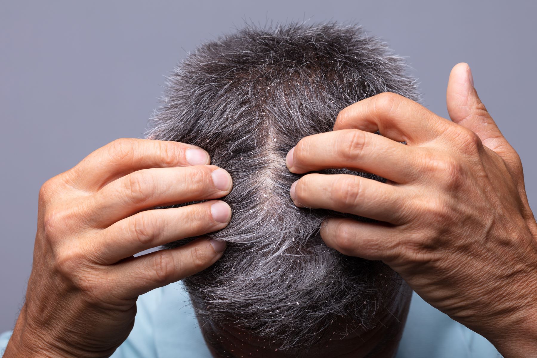 Patient with dandruff