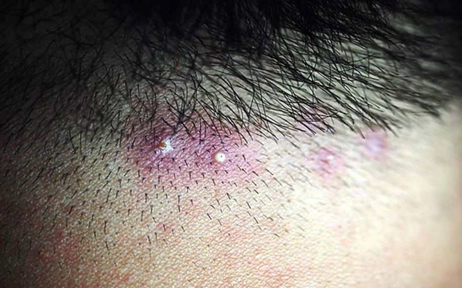 Patient with infectious folliculitis