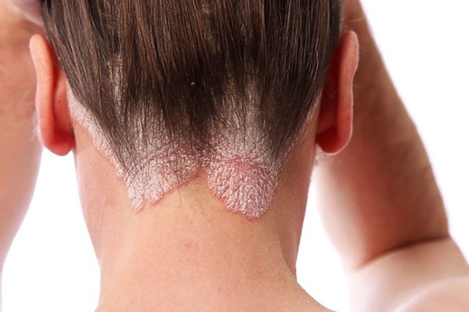 Patient with scalp psoriasis