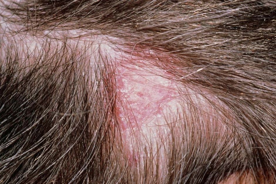 Patient with scalp ringworm