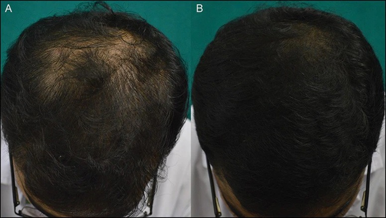 Results before and after 24 weeks of scalp Botox injections.