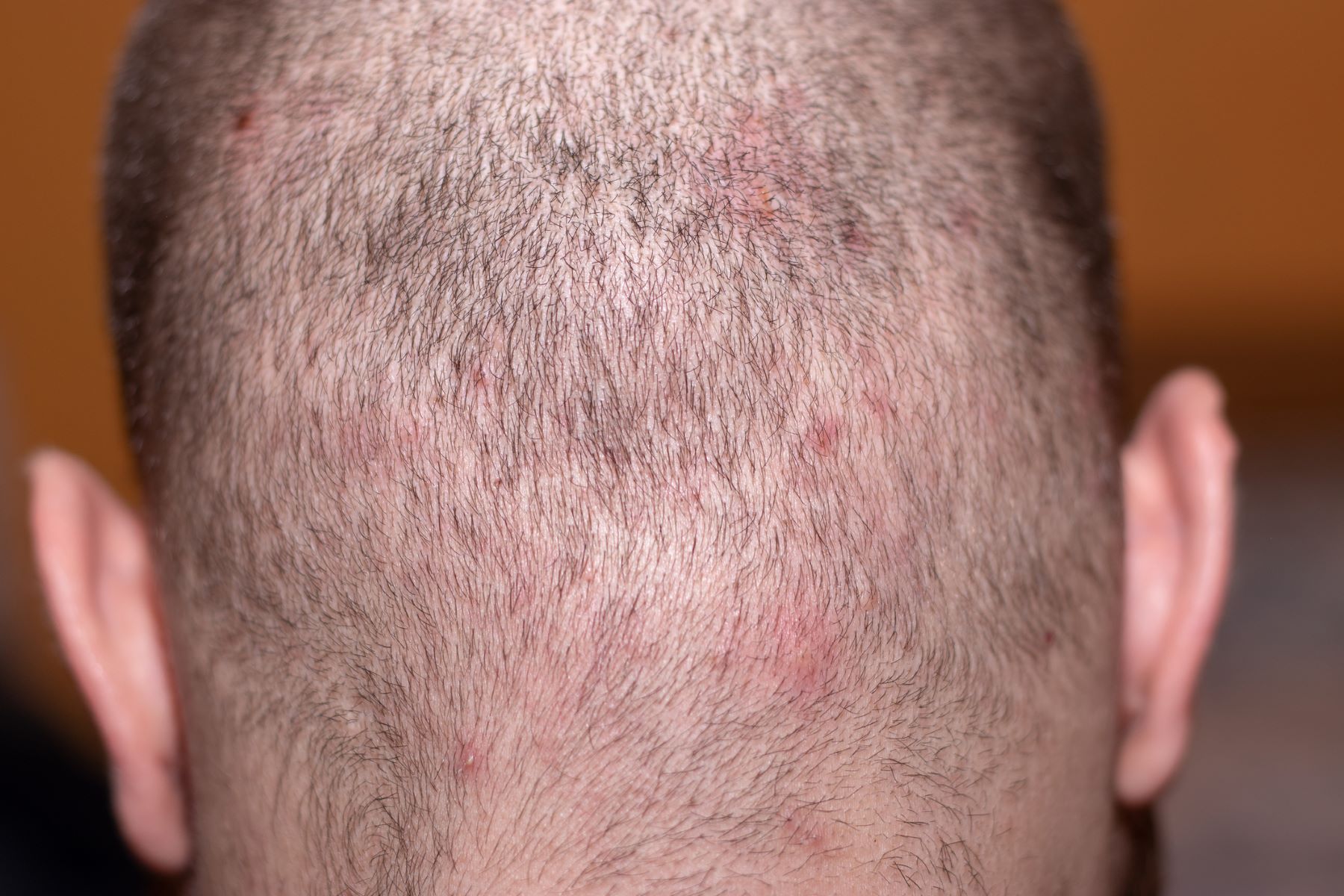 Scalp acne