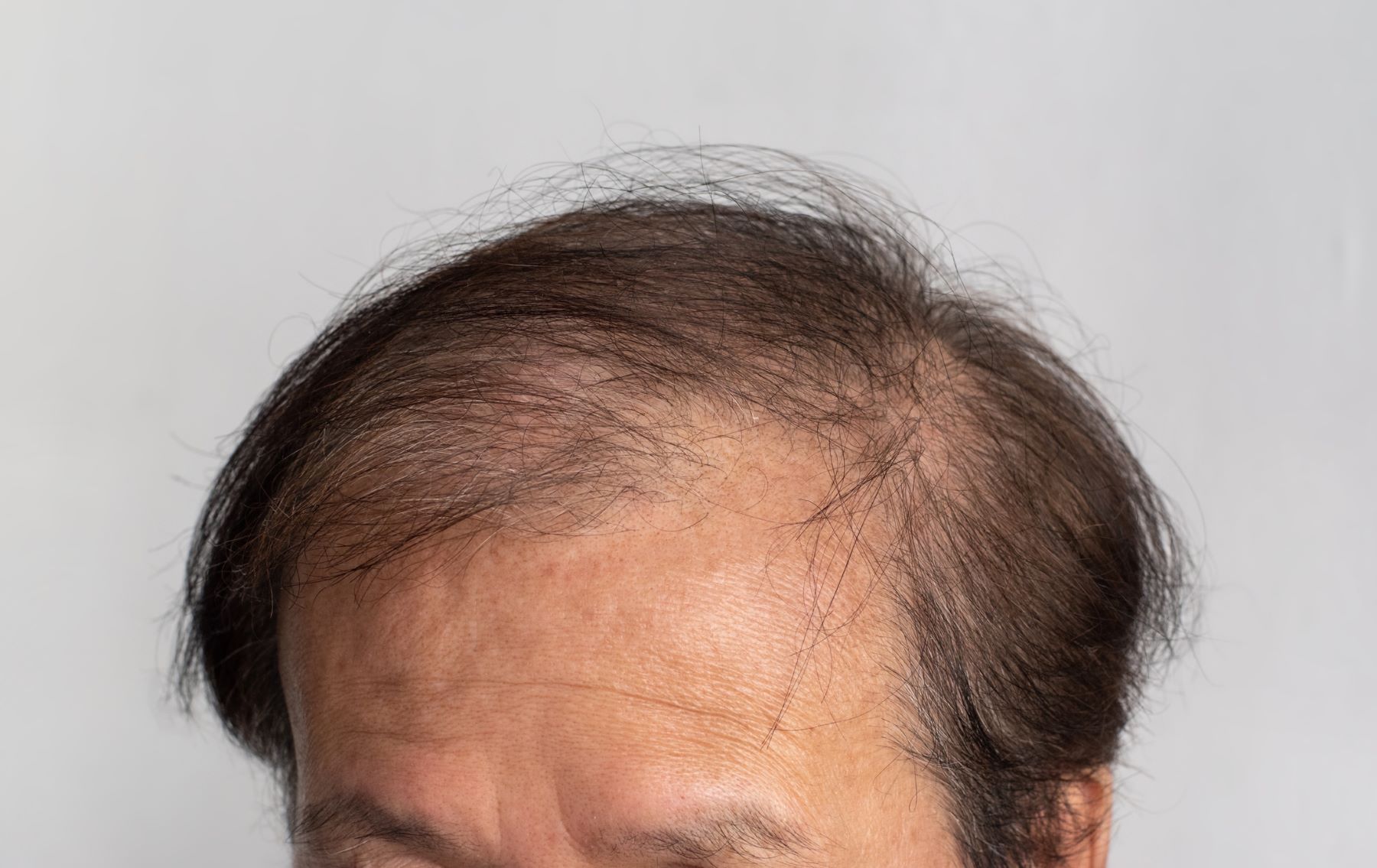 Thinning hair disguising hairline recession with a combover