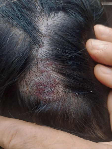 Tinea Capitis or Fungal Infection on the scalp of a woman