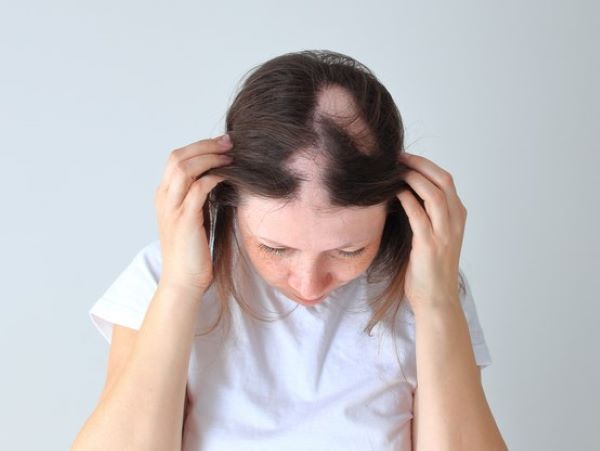 Woman with autoimmune hair loss