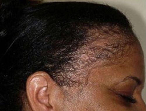 Woman with mechanical hair loss