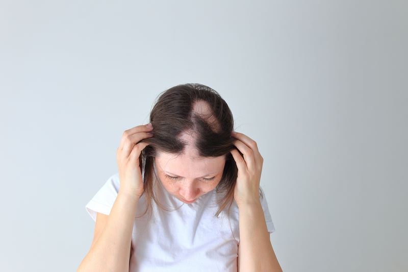 Woman with patchy alopecia areata