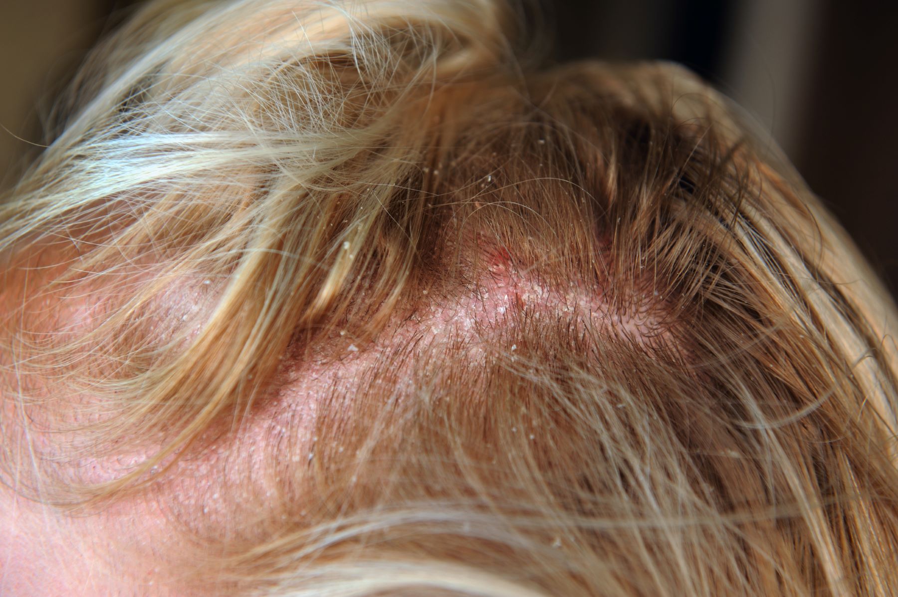 Woman with seborrheic dermatitis