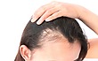 Female Hair Loss