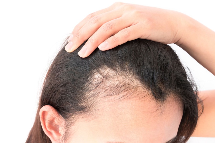 What Hormone Causes Hair Loss In Females?