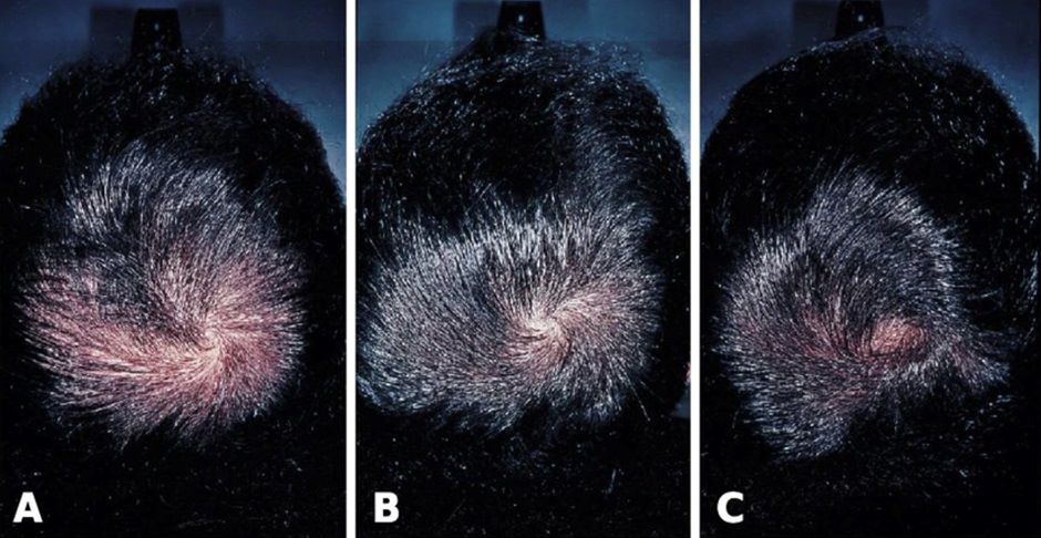 Before and after Finasteride treatment