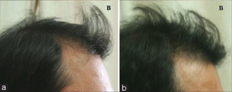 Before and after Minoxidil treatment