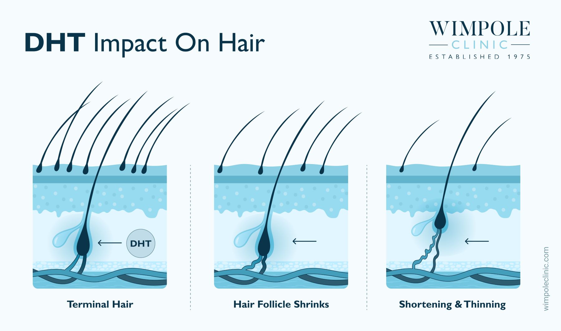 DHT impact on hair