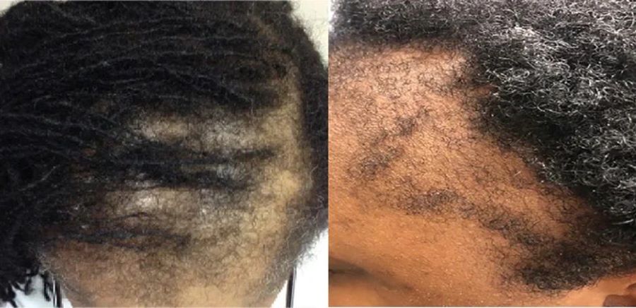 Female patients with traction alopecia